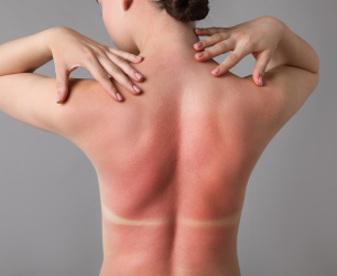 Sun Damage & Tan Removal